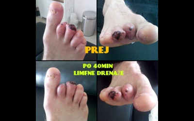 Ročna limfna drenaža pomaga pri amputaciji